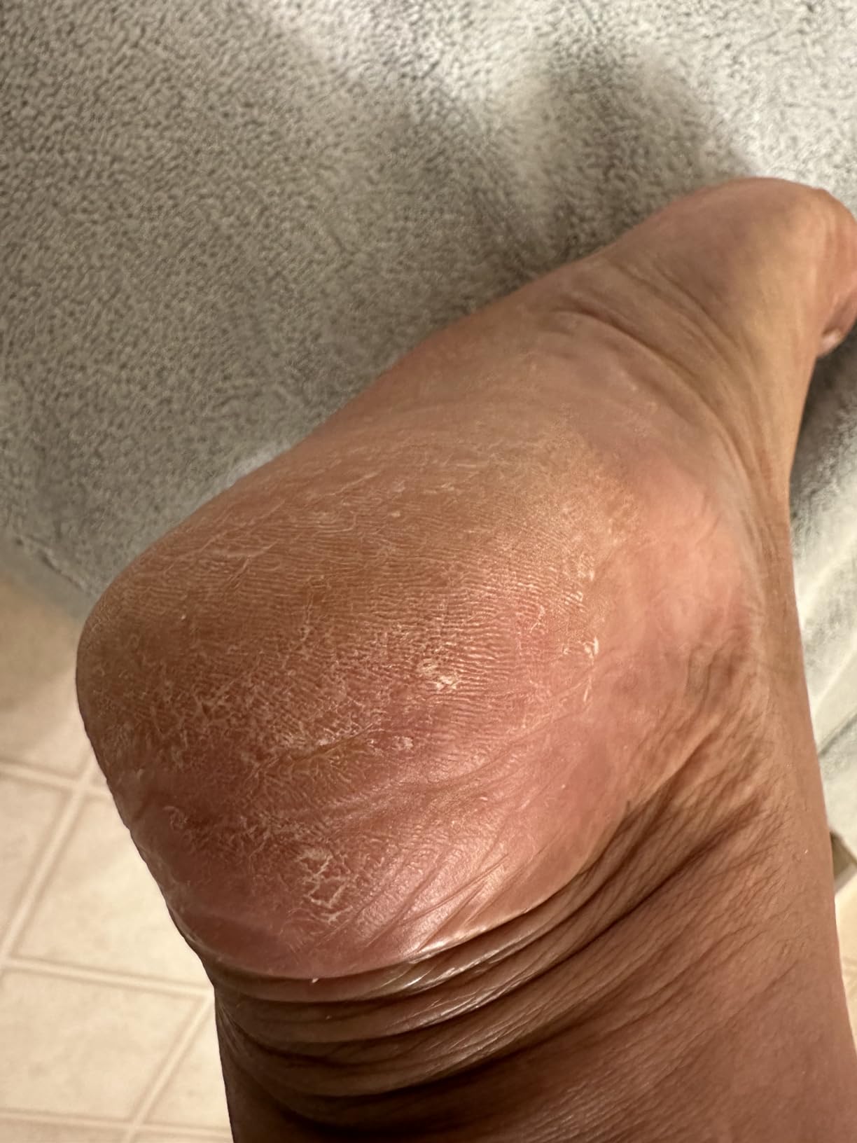 Probelle Double Sided Multidirectional Nickel Foot File Callus Remover - Immediately Reduces calluses and Corns to Powder for Instant Results, Safe Tool (Dark Grey) customer photo 1