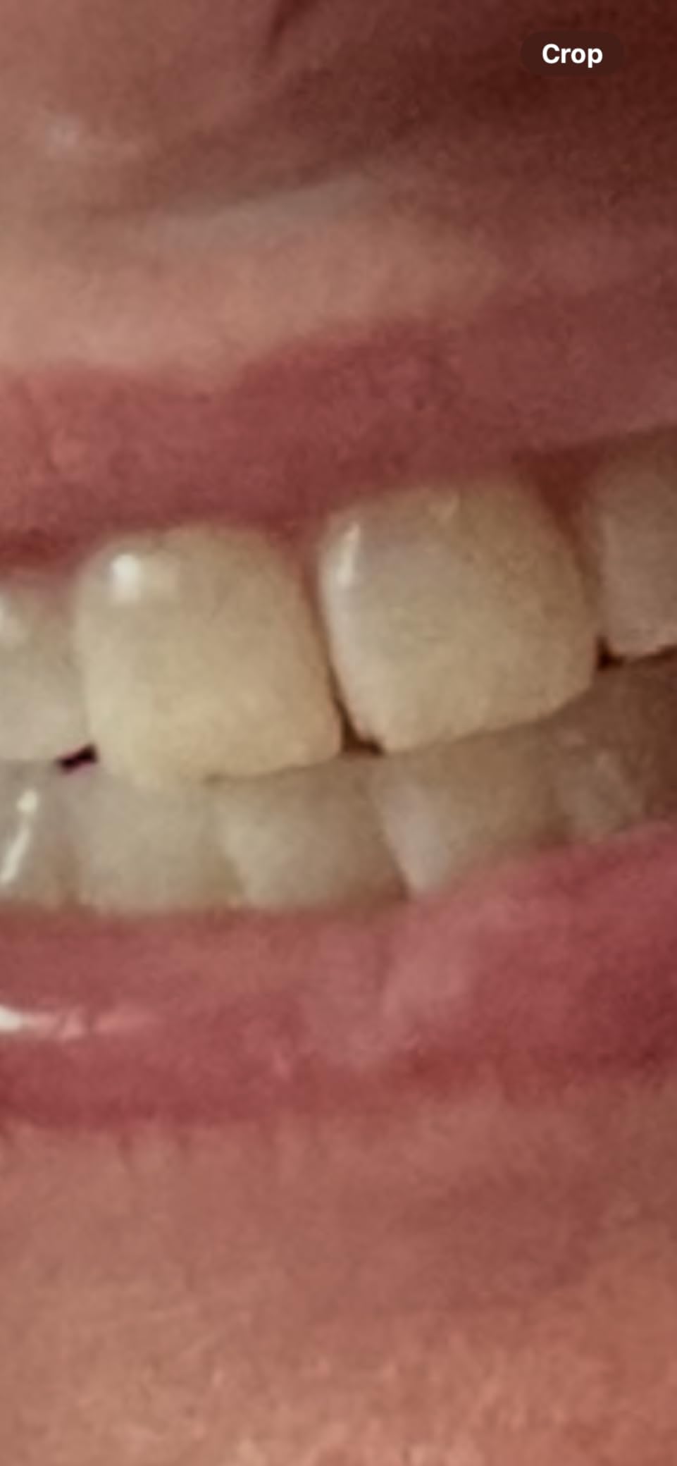 Lumineux 2-in-1 Teeth Whitening Pen, Removes Coffee & Tea Stains customer photo 2