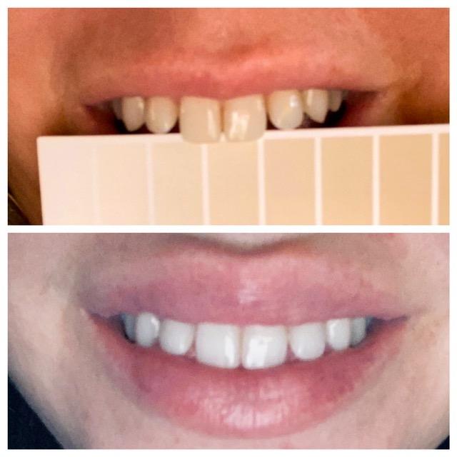 MySmile Non-Sensitive Teeth Whitening Pen Mint Gel Enamel Safety 8ML 30+ Treatments Fast Remove 20 Years of Stains Care Oral Bright Smile Alternative Teeth Whitening Strips customer photo 1