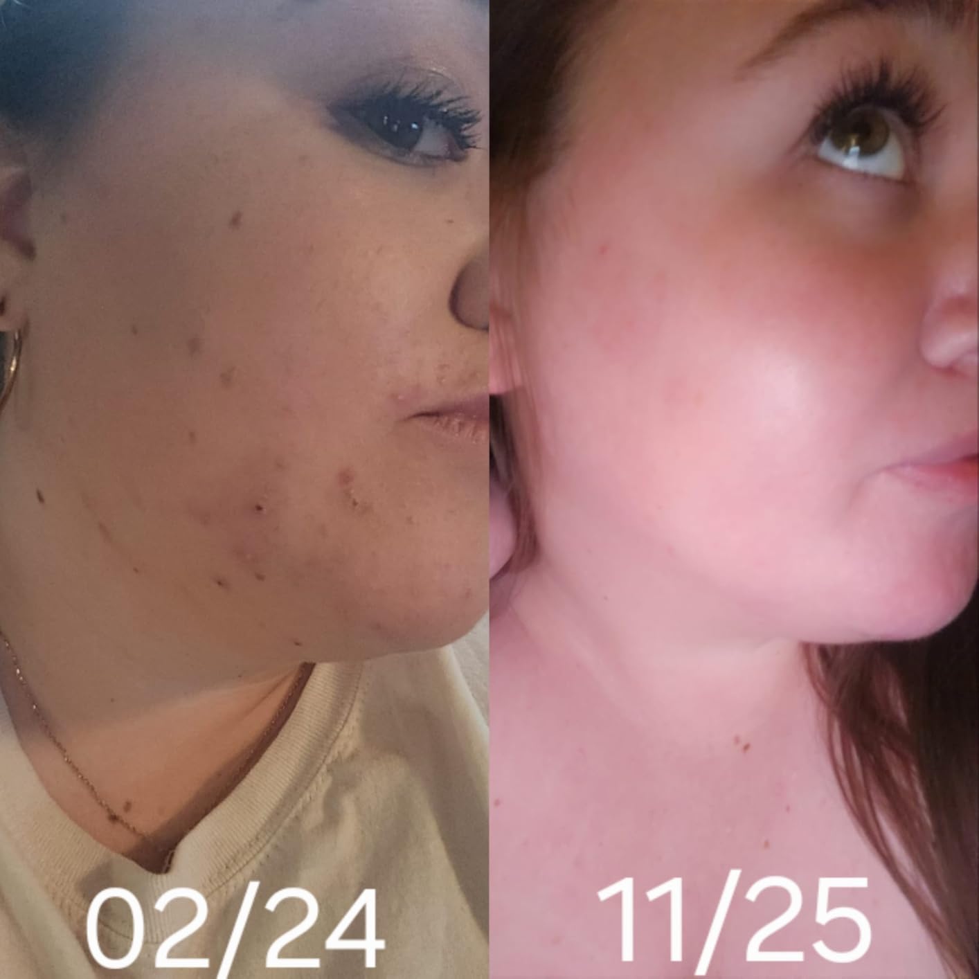 COSRX AHA/BHA Treatment Toner for Whiteheads & Clogged Pores, 5.07 fl.oz customer photo 2